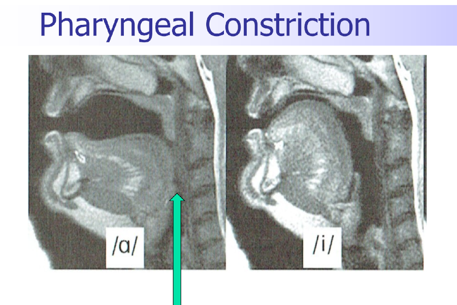 MRI scan demonstrating pharyngeal constriction, showing the root of the tongue closing the pharyngeal area during the production of the vowel sound in the word 'talk'.
